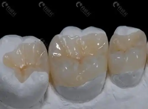 复合树脂补牙优劣势