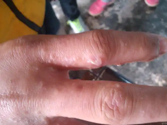 半月前无诱因出现双手掌如图所示伴瘙痒介疮