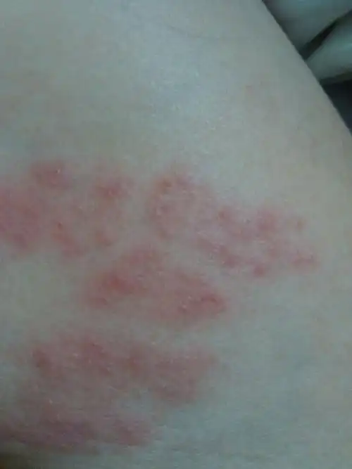 大腿内侧出现成片红疙瘩,又痛又痒,是什么症状?如何治疗?