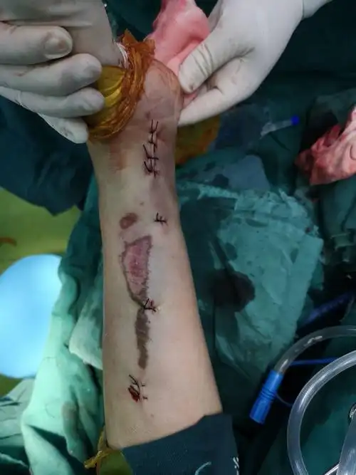 术后伤口外观照