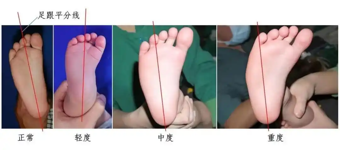 内八字,外八字?孩子脚型正常不正常,家长可以这样判断