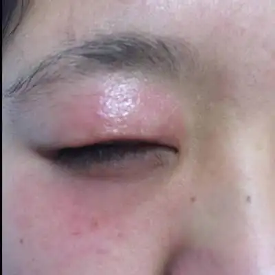 现在马上四个月了,连续三天一到晚上上眼皮就肿了,有点痒,这是为什麼