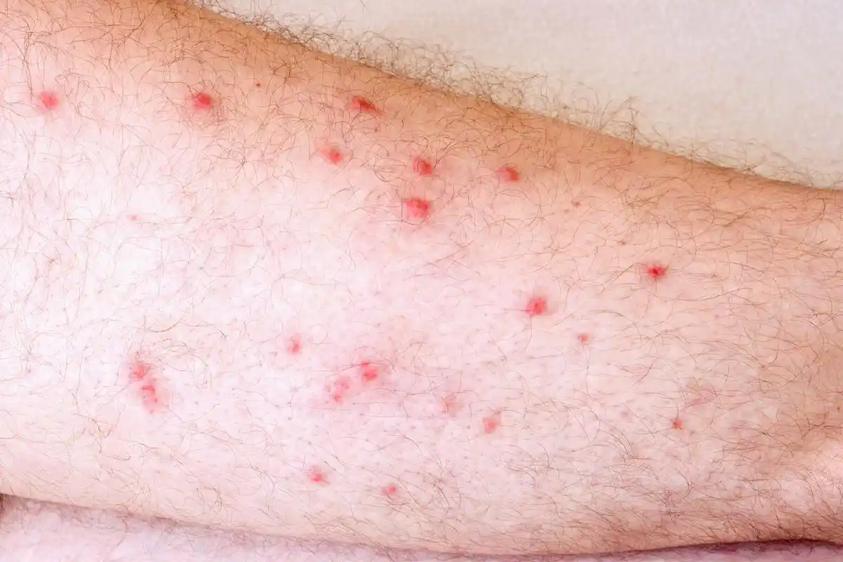 5到一厘米左右,略突出于皮肤表面,实际上呢,这种小红点就是樱桃状血管