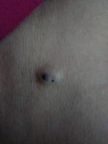 这个疙瘩硬前些天有点痛痒的感觉现在不疼了请问这啥东西