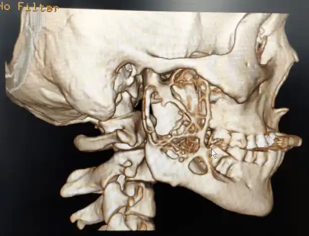 目前,口内入路行下颌骨巨大肿瘤鲜有报道.