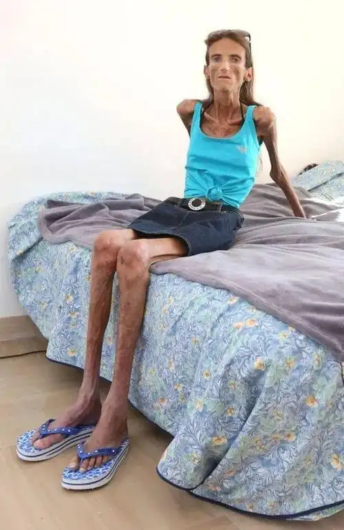 世界上最瘦的人,从开朗自信到堪称行走的骷髅