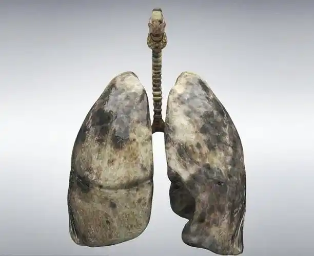 38岁男子查出肺癌平时不抽烟提醒2个习惯已把肺伤透