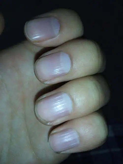 本人男,十八岁.我的指甲似乎不太正常