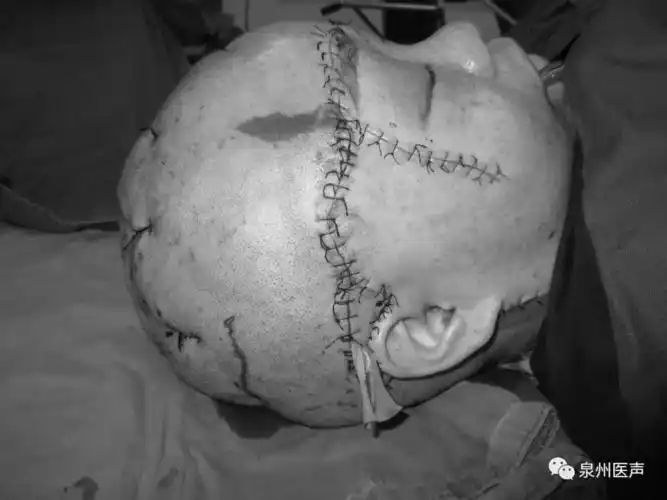 又一例!女子长辫被卷机器致头皮完全撕脱!