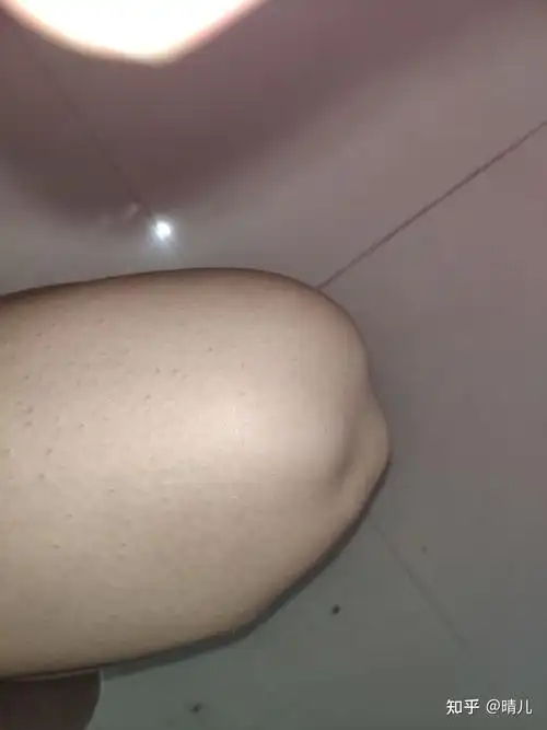 膝盖骨突出正常吗