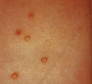 女性一期梅毒症状图片