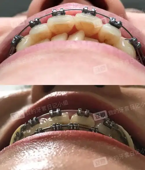 正畸中 侧脸对比 内收对比 60天860天