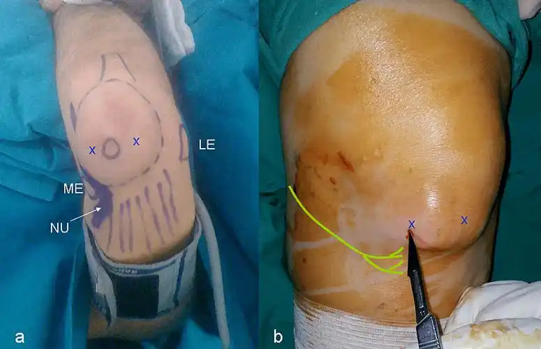 缓解症状尺骨鹰嘴滑囊炎的缓解旨在拉伸和加强手臂肌肉,这些肌肉可能
