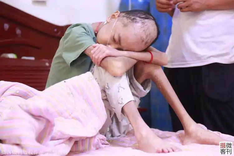 12岁男孩瘦成皮包骨24小时吸氧姐姐掏鸡粪救患病弟弟