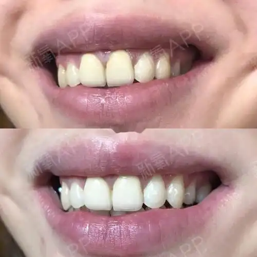 也可以定制你想要的颜色 我是3年前吧做的烤瓷牙 我只做了门牙两颗 做