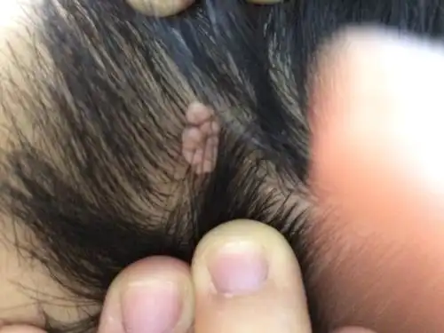 头发长了肉疙瘩.很小的时候就有,不疼不痒.