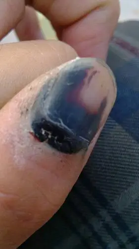 现在黑黑的,也不疼了,但是我发现指甲根这里已经自行裂开,怕怕的,我