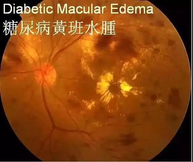 爱眼讲堂正确认识糖尿病性视网膜病变