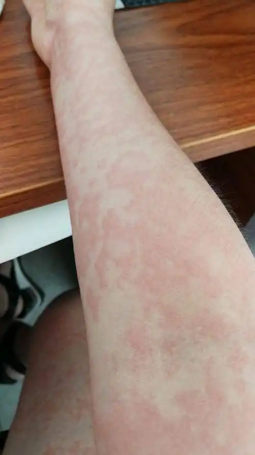 为什么你的荨麻疹治不好?