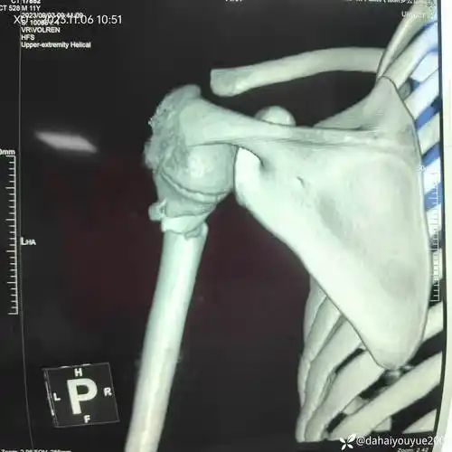 病例万能克氏针治疗儿童肱骨近端骨折