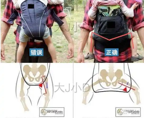 没弄清楚这些之前,千万不要随便使用|宝宝|背带|髋关节_新浪育儿_新浪