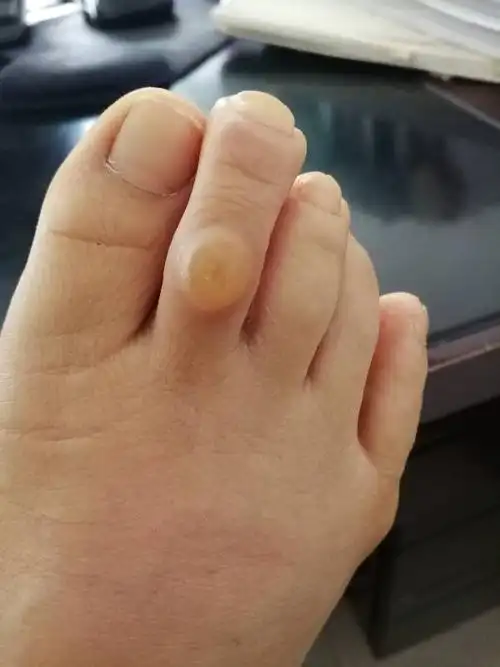 脚趾上长了个包,不能穿皮鞋,顶着疼,去医院看什么科?