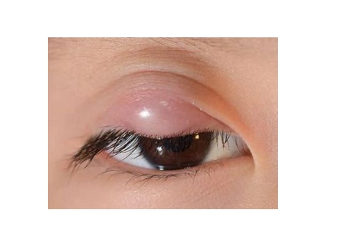 眼睛麦粒肿初期图片7