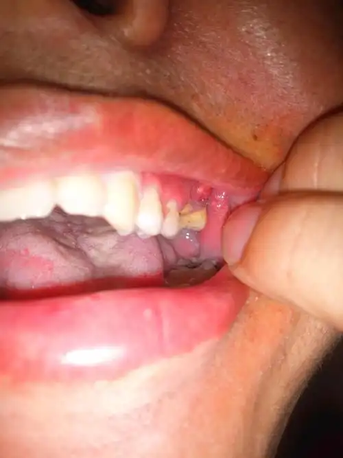 你好 大夫牙龈肿了有三天,以前由于周边牙周神经疼,所把神经线已切除