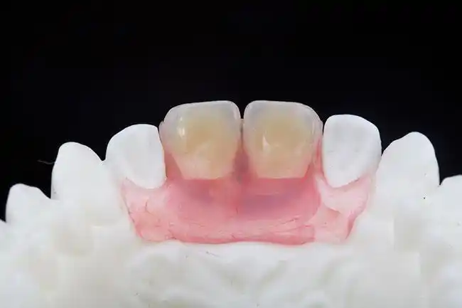 隐形义齿 - 北京圣爱吉友和义齿制作有限公司