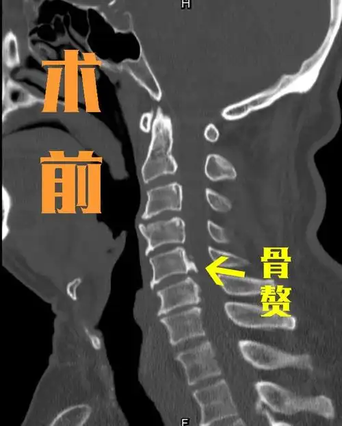 颈椎病做前路手术更好?若后方骨质增生,还能做前路手术吗?