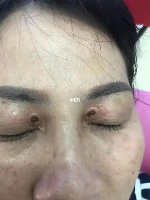这叫睑黄疣