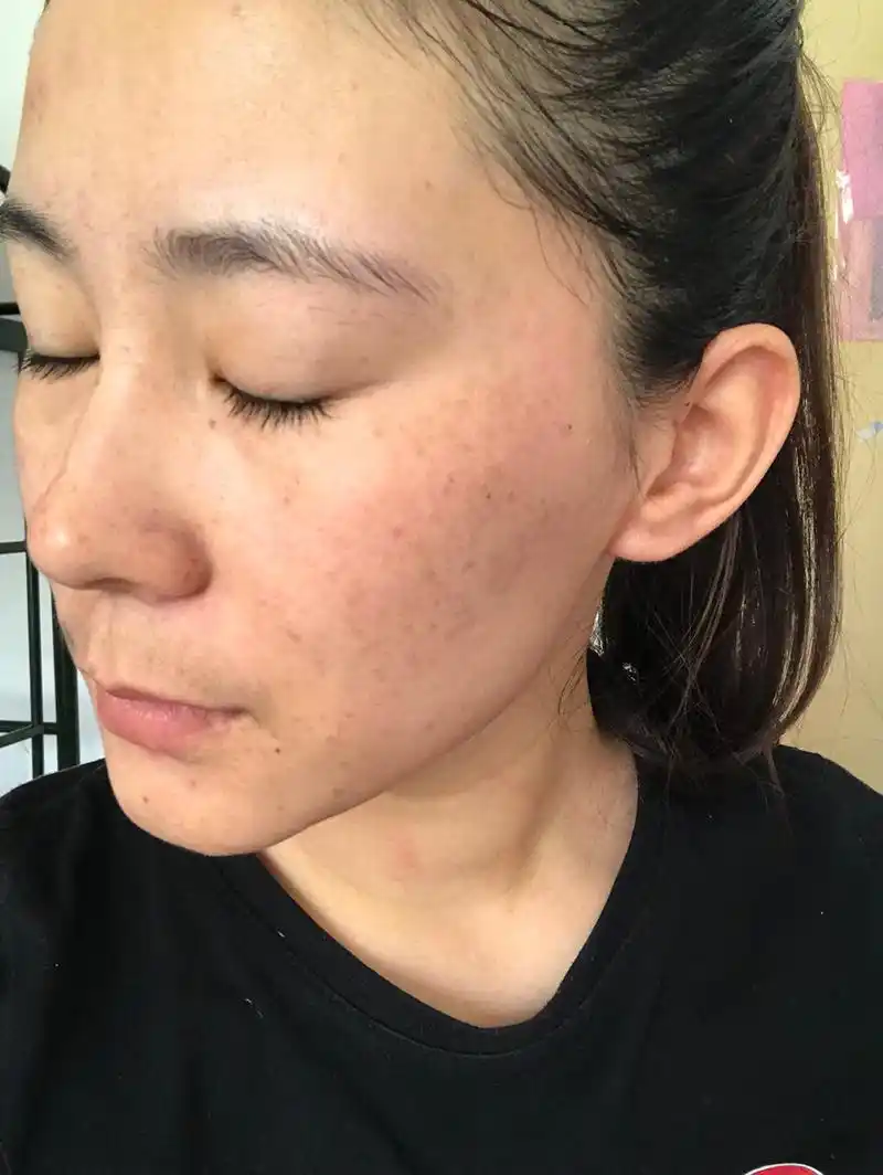 3月1号做的超皮秒,快3个月了,反黑很久很久,现在下去很多了