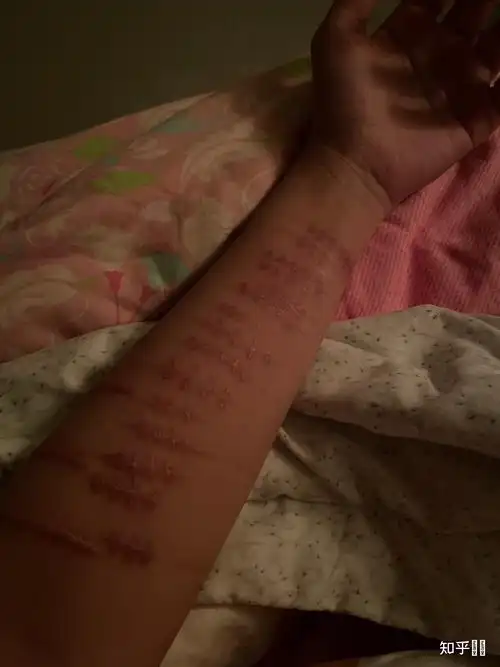 割腕的疤可以去掉吗