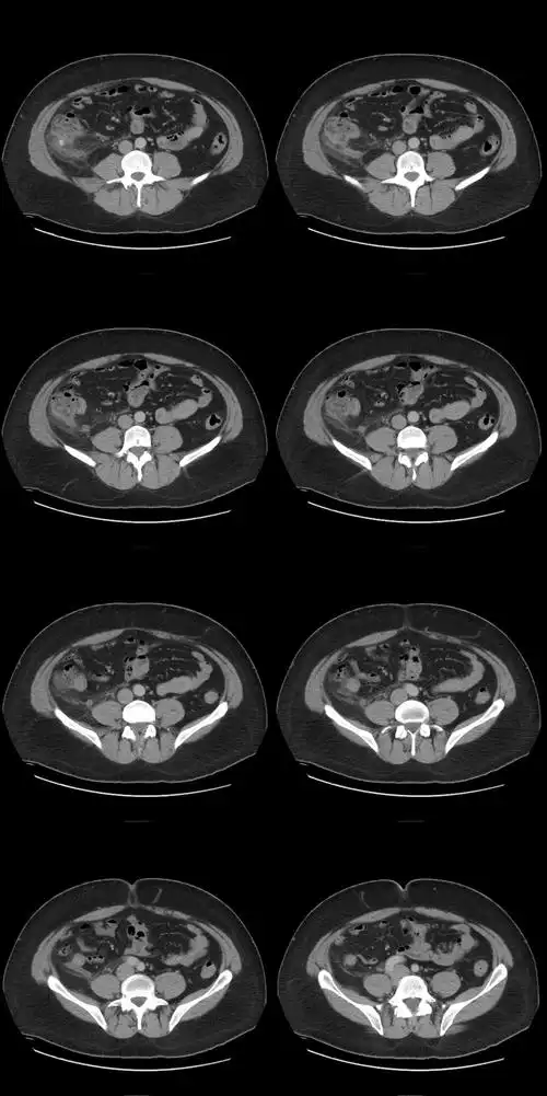 容易被误诊的右下腹疼痛之盲肠憩室炎