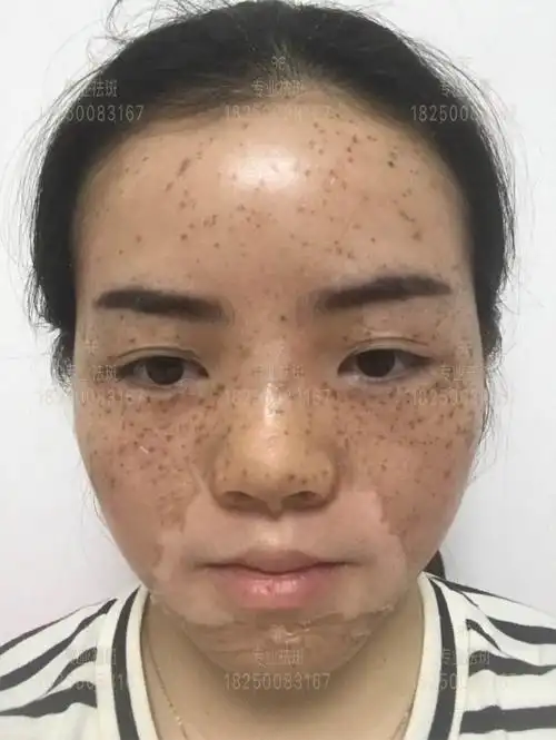 液氮冷冻祛斑 - 知乎