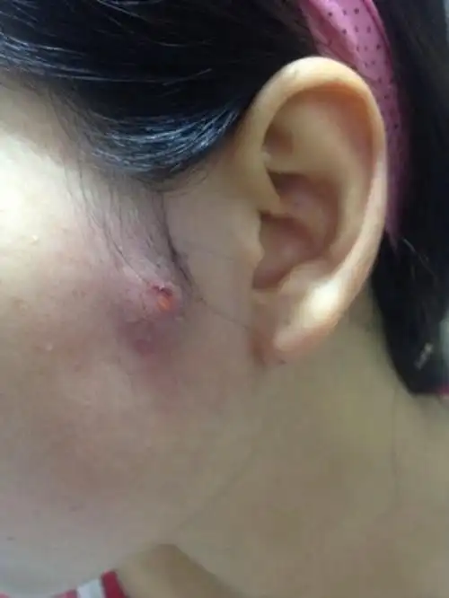 耳朵后边的皮脂腺囊肿图片