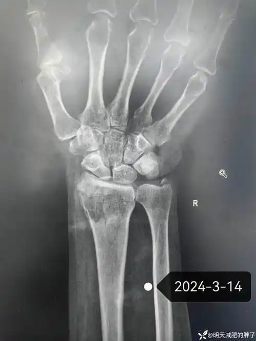 桡骨远端骨折保守治疗失败