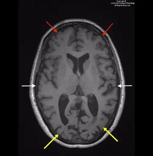 mri上顶枕叶皮质萎缩 你考虑的诊断是?