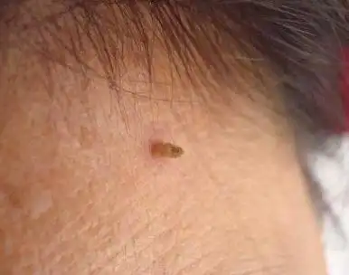 丝状疣是由人类乳头瘤病毒(hpv)所致的病毒感染性疾病,俗称线瘊.