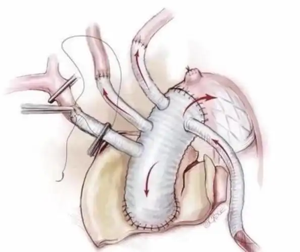神同步了不起省人医一晚同时救治3例主动脉夹层患者