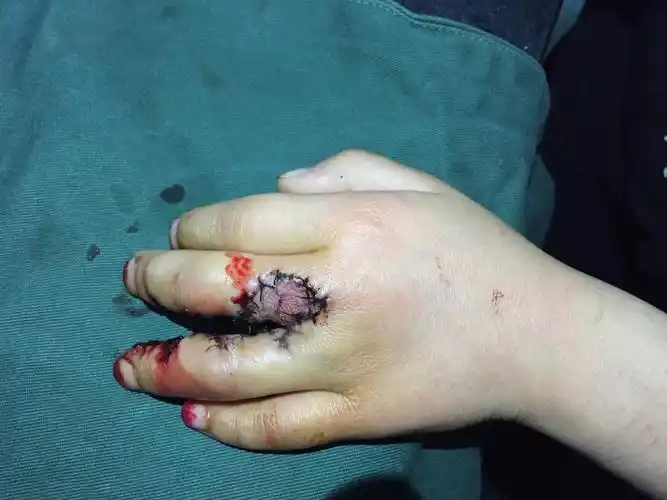 术后7天拆除植皮包,皮瓣及植皮区全部成活