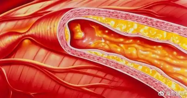 动脉硬化来临之前会有这6个信号出现了说明你的血管变硬了