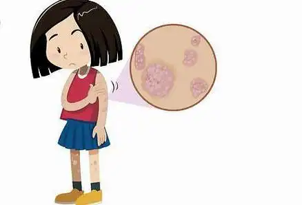 银屑病即牛皮癣,中医认为银屑病多为营血亏损,血热内蕴,化燥生风等