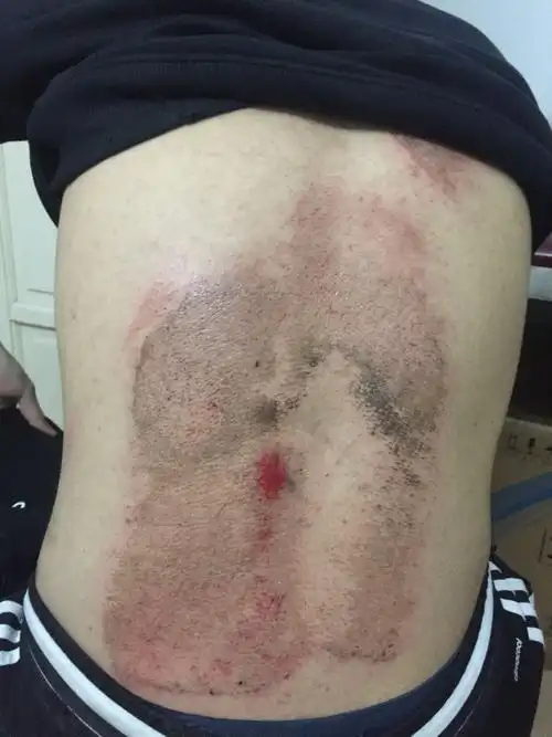 背部挫伤怎么恢复快啊?