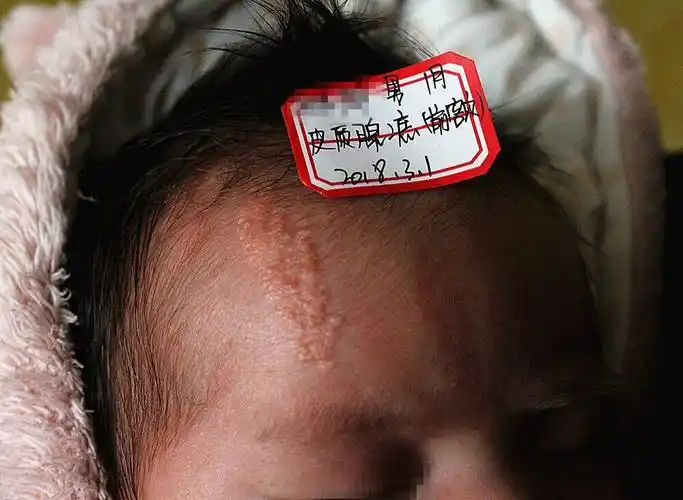 邓主任胎记大课堂之满月宝宝长胎记能不能做手术