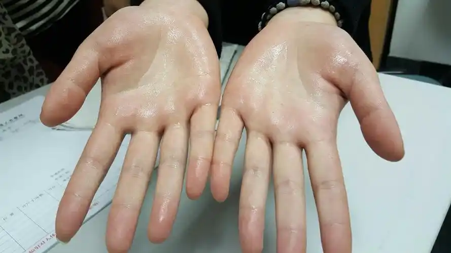 手汗症 周末24小时出入院手术(广东省人民医院胸外科)