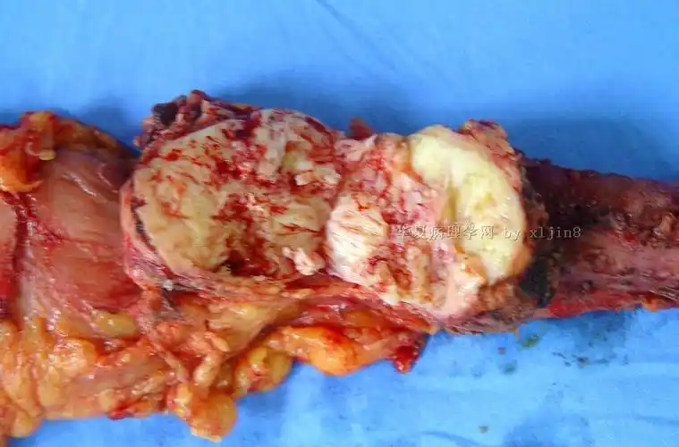 女/40岁 胰腺肿瘤 冰冻诊断?