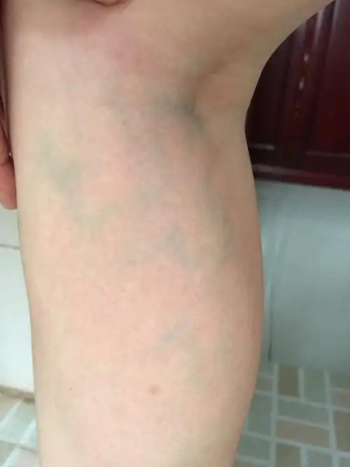 您好苏医师如下图片请问这是静脉曲张第几期目前需要穿静