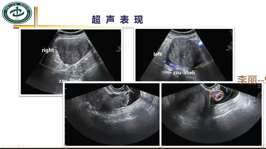 女性附件蒂扭转的超声诊断思路