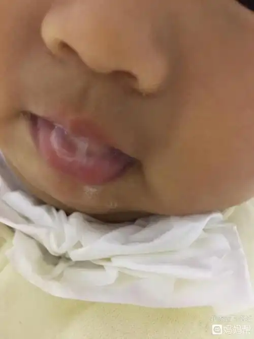 1症状不同新生儿肺炎吐泡泡的同时会伴随有体温升高,咳嗽等症状新生儿